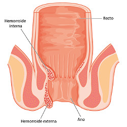 Tratamiento de la trombosis hemorroidal - Instituto Dr. Padrón